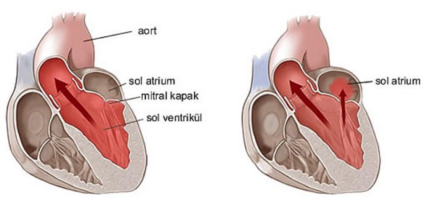 Kalbin içindeki mucize: Mitral kapak