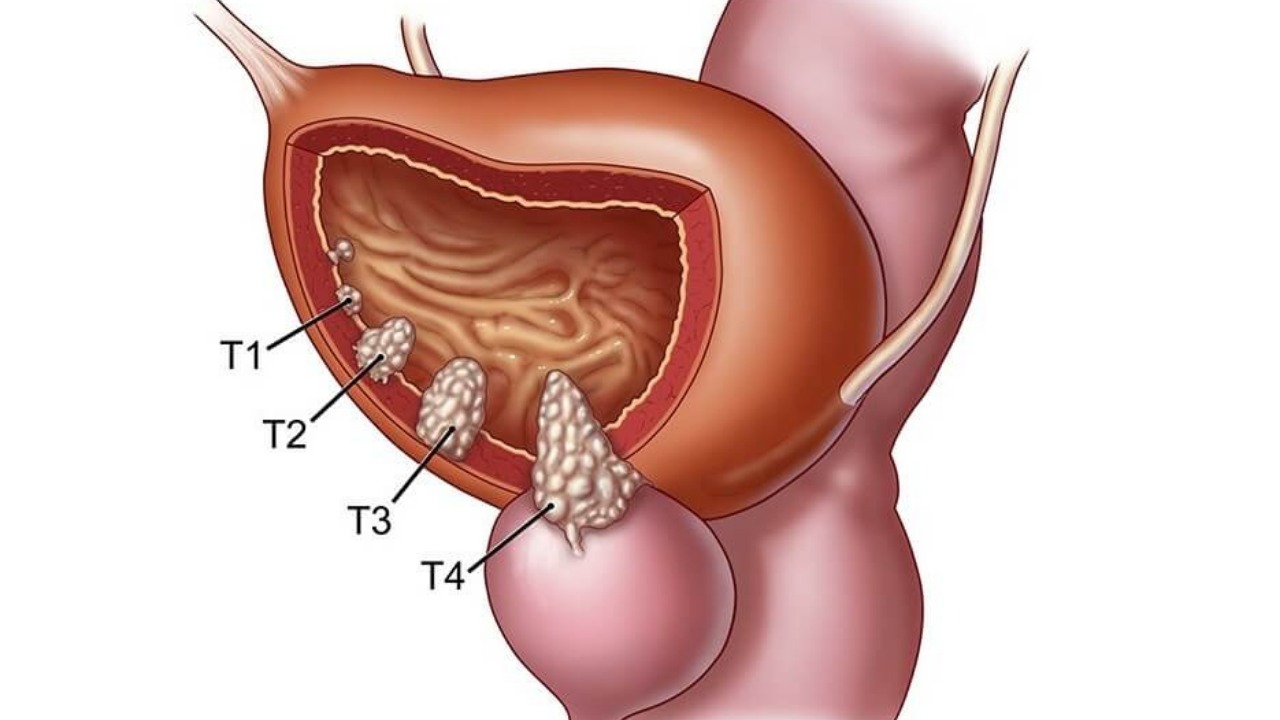 Mesane Kanseri Ameliyatı