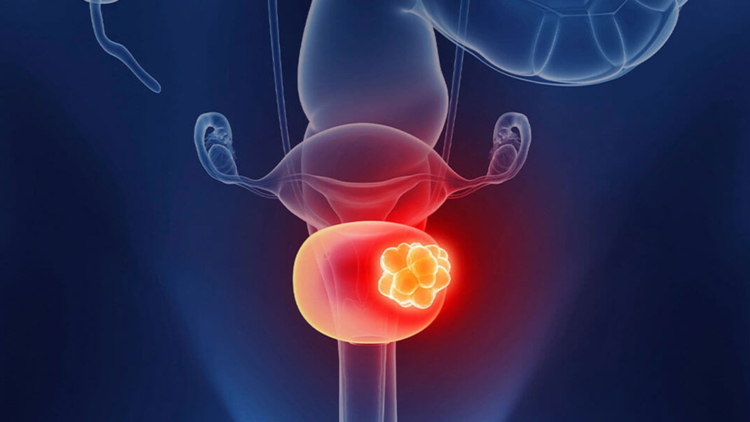 Mesane Kanseri Ameliyatı